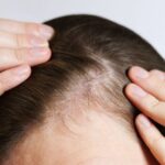 geheimratsecken-rezilin