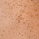 Hyperpigmentierte Haut behandeln: Reicht die Kressesalbe aus? hyperpigmentation